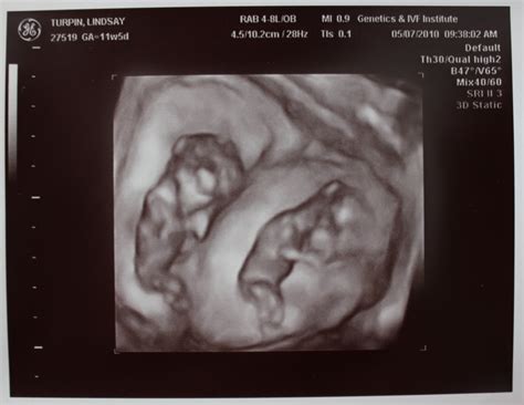 It's week 12 and you've made it to the last week of your first trimester. Adventures in Baby Making: 12 weeks ultrasound