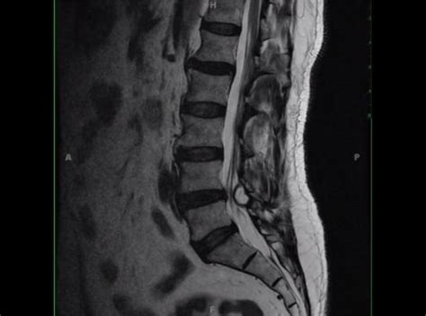 Spinal Cysts