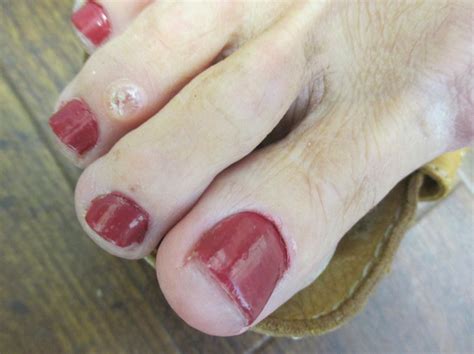 An Atlas Of Nail Disorders Part 7 Consultant360