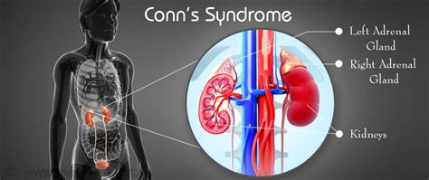 Conn S Syndrome Overview Faculty Of Medicine