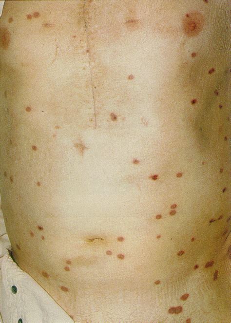 Gonorrhea Skin Rash Pictures Photos