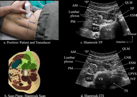 Ultrasound Visualization Of The Anatomy Relevant For Lumbar Plexus