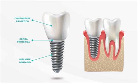 Partes De Un Implante Dental