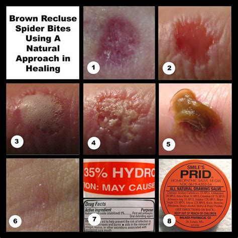 Brown Recluse Bite Stages Symptoms Diagnosis Treatmen