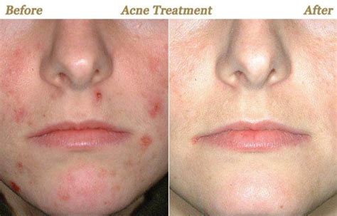 A few different side effects can appear after laser hair removal. Photos BOTOX Juvederm Photofacial Chemical Peel