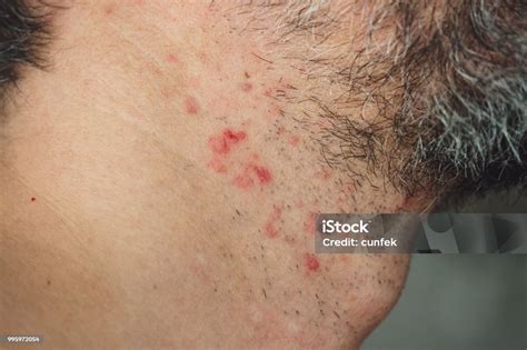 Rash Or Psoriasis Psoriatic Skin Disease Stock Photo Download Image