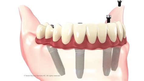 All On 4 Dental Implants Animation By Nobel Biocare Youtube