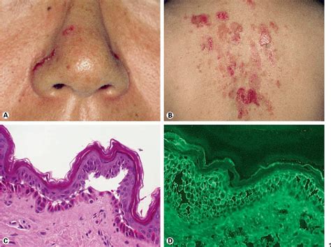 Figure 2 From Pemphigus Vulgaris With No Mucosal Lesions Showing