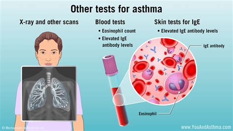 What Is The Blood Test For Eosinophilic Asthma