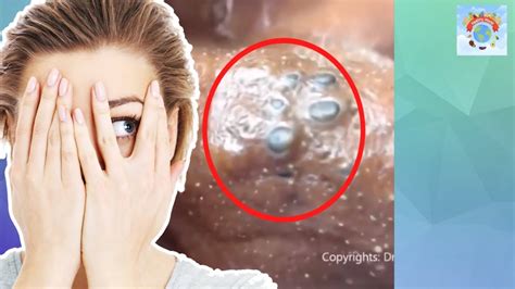The ~amazing~ blackhead removal you see in videos isn't actually as impressive as it seems. Biggest Blackhead ever - Black head removal 2019 Part4 ...