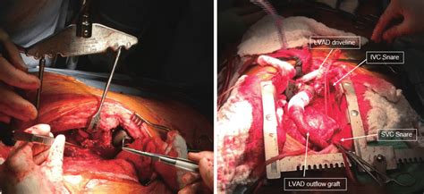 Figure 1 A A Redo Sternotomy In A Patient With Previous Lvad