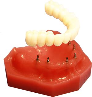 Mini Dental Implants | Clermont Dental Group | Mini dental implants, Dental implants, Dental ...
