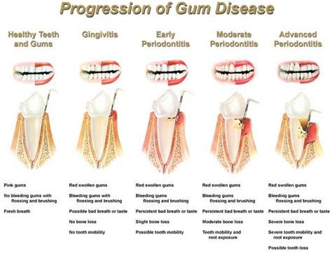 Progression Of Gum Disease Chart Visit Newton Dental Associates One