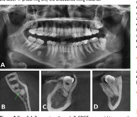 Figure 2 From Comparison Between Panoramic Radiography And Cbct Imaging
