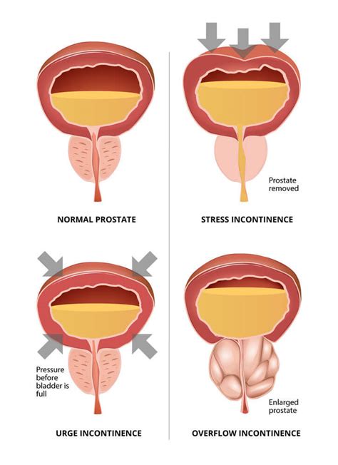 treatment for urinary incontinence after prostate surgery