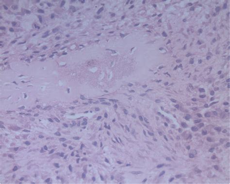 Histopathology Picture Showing Malignant Phyllodes Tumor With
