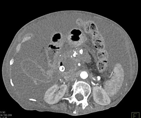 Pancreatic Cancer In A Patient With Chronic Pancreatitis Pancreas