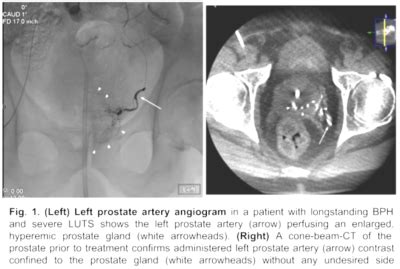 Prostate Artery Embolization Radiologic Imaging Consultants