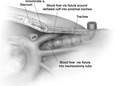 Technique For Managing Tracheo Innominate Artery Fistula Operative Techniques In Thoracic And