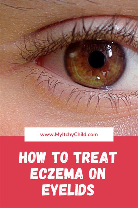 How To Treat Eczema On Eyelids Eczema On Eyelids How To Treat Eczema