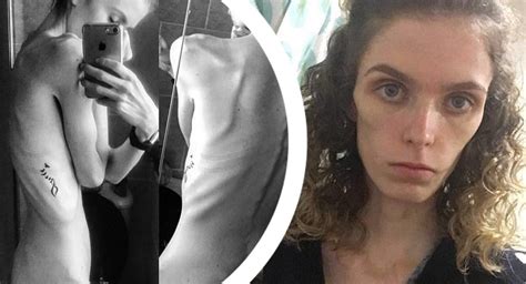 Sobreviviente De Anorexia Llegó A Pesar 38 Kilos Hoy Revela Secreto De Cómo Superó Su