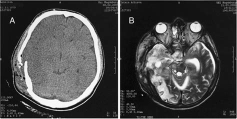 26 Yo Patient With Traumatic Brain Injury A Ct Scan Only Shows