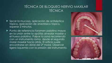 Anestesia Dental Nervio Maxilar Universidad Austral Chile Youtube