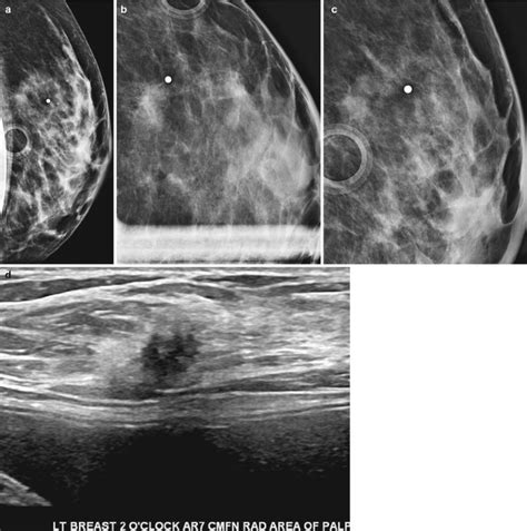 Mammographic Signs Of Breast Cancer Springerlink