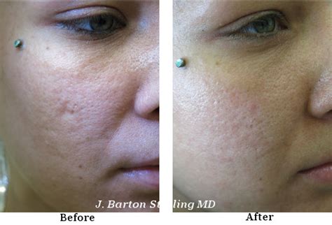 Acne Scars Removal And Treatment J Barton Sterling Md