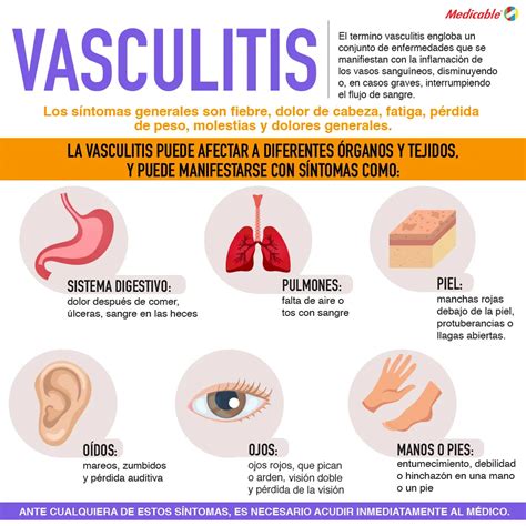 Vasculitis Medicable