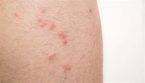 Swollen Blisters On The Skin Caused By Mosquito Bites At Thigh Stock
