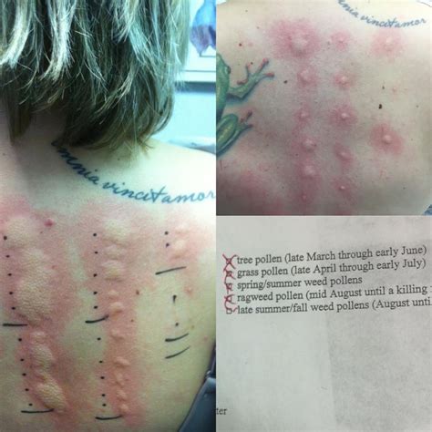 Allergy Scratch Tests Before Left And After Top Right A Year Of