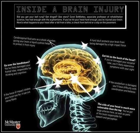 Inside a brain injury Infographic | Brain injury, Injury