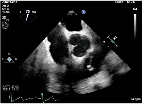Midesophageal Right Ventricular Inflow Outflow Tee View Obtained During