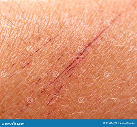 Scratches On Human Skin As Background Stock Image Image Of Effect