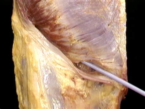 Genitofemoral nerve spermatic cord (male) or vaginal process (female) male spermatic fascia (loose external & dense internal) cremaster muscle (dog; The inguinal canal | Acland's Video Atlas of Human Anatomy