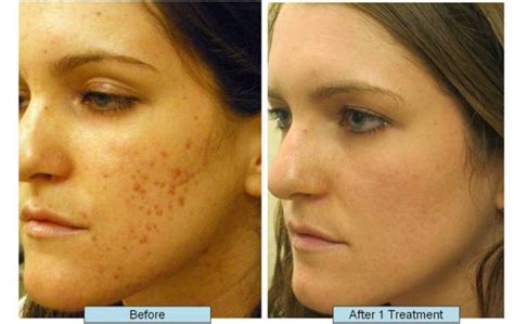 What Helps With Acne Scars Skincarederm