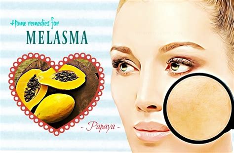25 Natural Home Remedies For Melasma Treatment