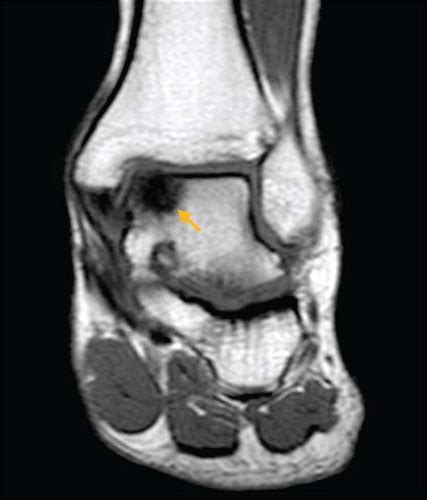 Osteochondral Lesion Of The Talus Journal Of Orthopaedic And Sports