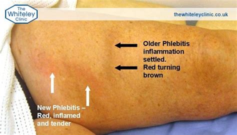 Symptoms Of Phlebitis The Whiteley Clinic