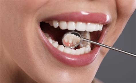 Oral Cancer Screenings Brandon Ms Dentist Germany Dental