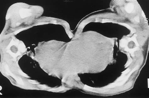 Imaging In The Preoperative Assessment Of Conjoined Twins Radiographics