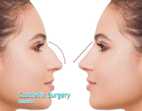 Global Recognition Of Mexican Cosmetic Surgery Top Surgeons Mexico
