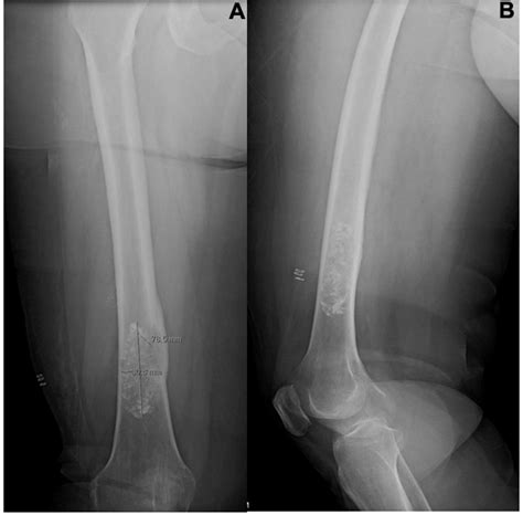Ap 1a And Lateral 1b X Ray Views Of The Right Femur Demonstrate A