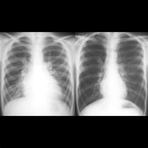 Asthma Chest X Ray