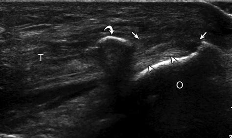 Fig 163 Triceps Brachii Partial Thickness Tear Ultrasound