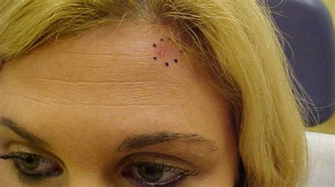 Early Stage Skin Cancer On Forehead Cancerwalls
