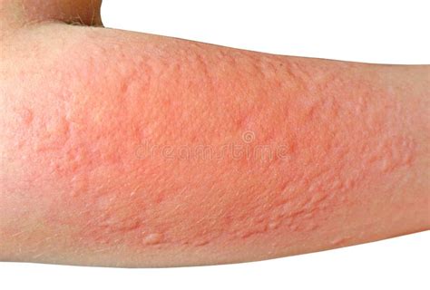Allergic Contact Dermatitis At Shin Stock Image Image Of Care Elbow