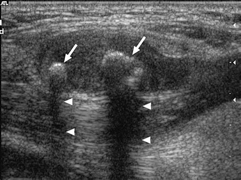 Longitudinal Sonogram Showing A Lymph Node Involved With Mycobacterial