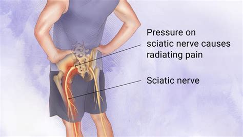 Sciatica Sufferers Listen Up Chiropractic Care Reduces Pain Promotes